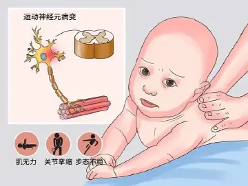 专家科普|全国3000万“隐形携带者”!SMA筛查真的有必要吗?