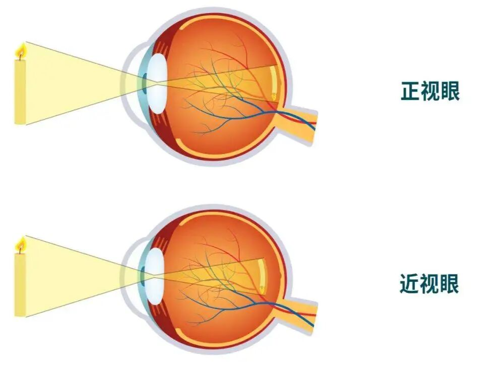 专家科普｜为啥同学不近视？原来他们每天都做这三件事