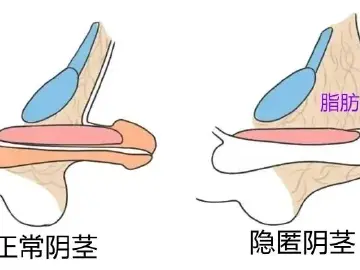 专家科普｜家有男宝请注意：这种包皮不能割 