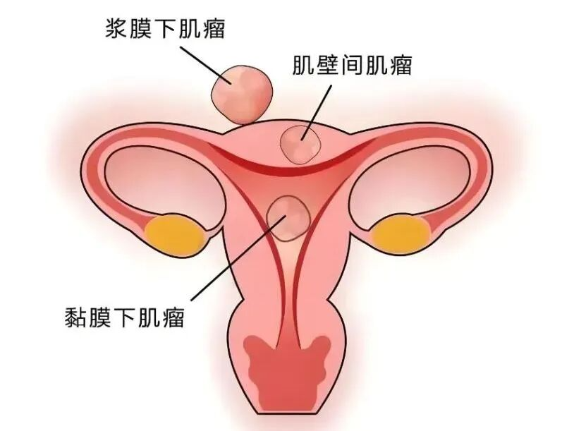 专家科普｜肚子鼓成孕7月，邻居以为怀二胎？竟是多发性子宫肌瘤在搞事 