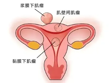 专家科普|肚子鼓成孕7月,邻居以为怀二胎?竟是多发性子宫肌瘤在搞事