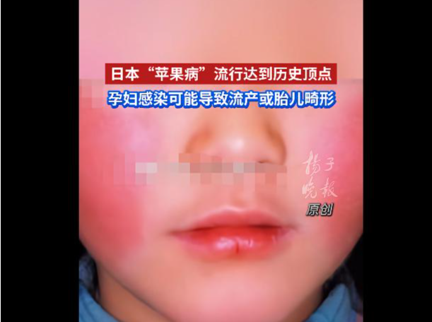 日本“苹果病”流行达到历史顶点，孕妇感染或致严重后果