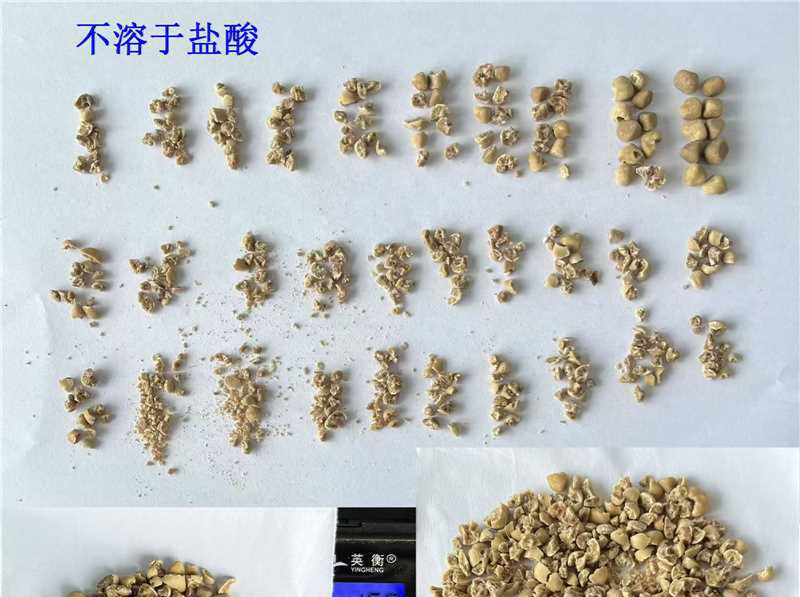 夜尿多“扛”了十年，七旬老人膀胱里竟“藏”着40多枚结石