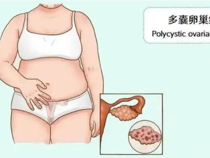 专家科普｜多囊卵巢综合征就是不孕吗？老公也要检查吗？ 