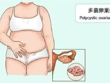 专家科普|多囊卵巢综合征就是不孕吗?老公也要检查吗?