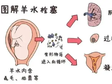 专家科普|羊水栓塞真的这么可怕吗?