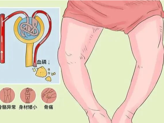 专家科普｜不是所有的佝偻病，都是缺钙引起的 