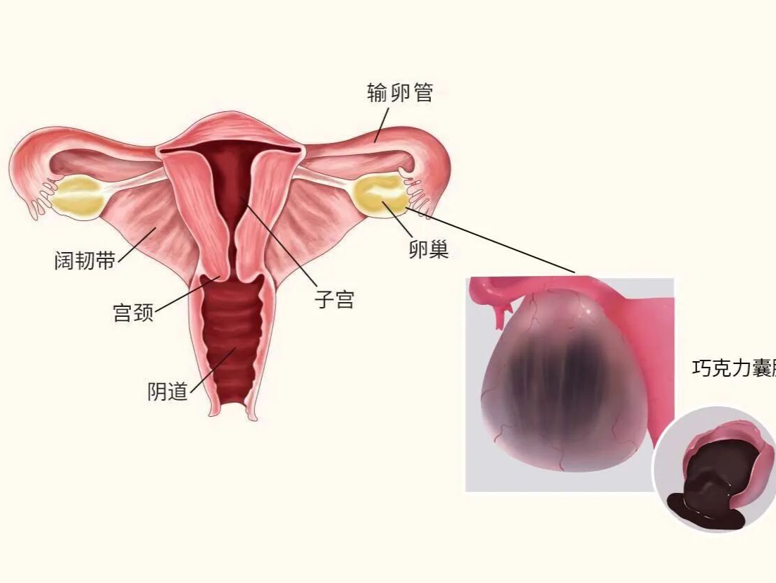 专家科普｜巧克力囊肿会癌变吗？