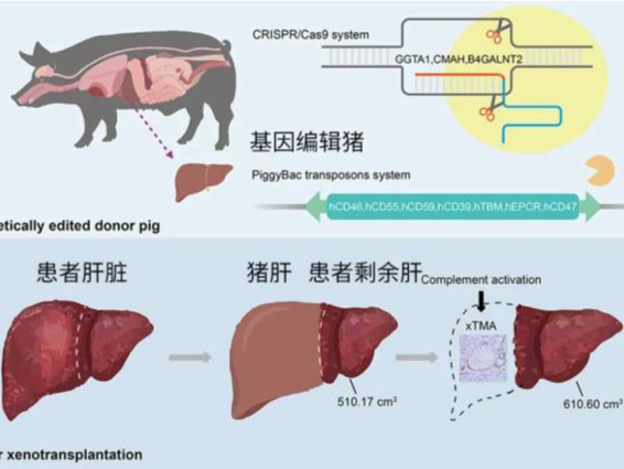 全球首例！中国团队成功将猪肝移植给活人 