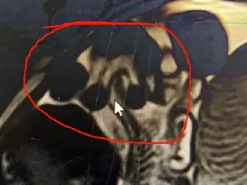 专家科普|产检时发现宝宝肚子裂开,这孩子还能留吗?