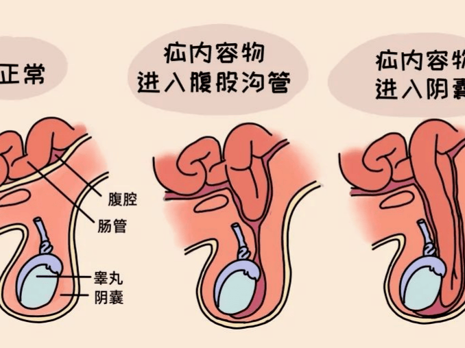专家科普｜娃查出疝气后，我变得“百依百顺”了 