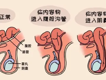 专家科普|娃查出疝气后,我变得“百依百顺”了