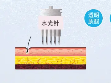 专家科普|你真的适合打水光针吗?
