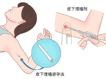 专家科普|50岁还有1000个卵?什么时候能停止避孕?