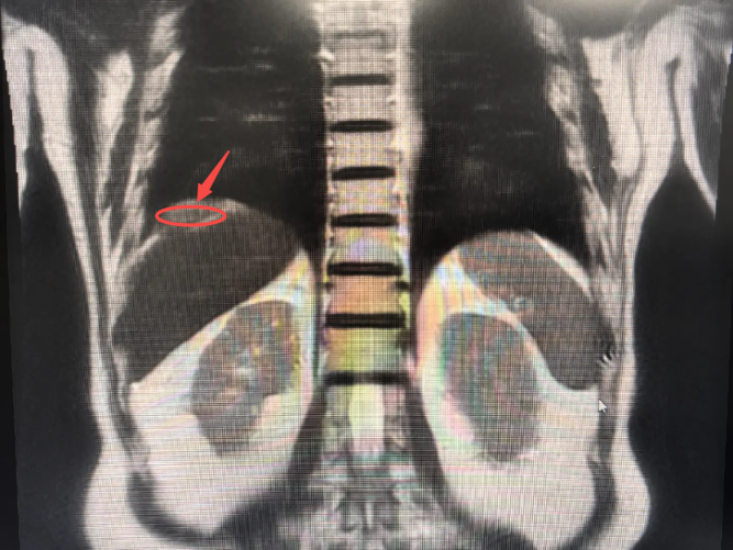 肿瘤紧挨“膈肌”！深圳前海泰康医院拆解“主炸弹”+清“小地雷”