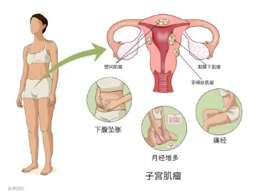 专家科普|母女同病,肌瘤疯长!背后真相竟藏在这?