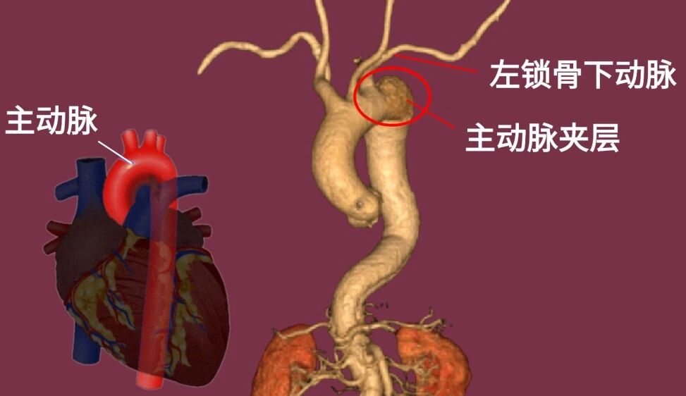 生命血管“劈叉”,医生“一个点”拆弹