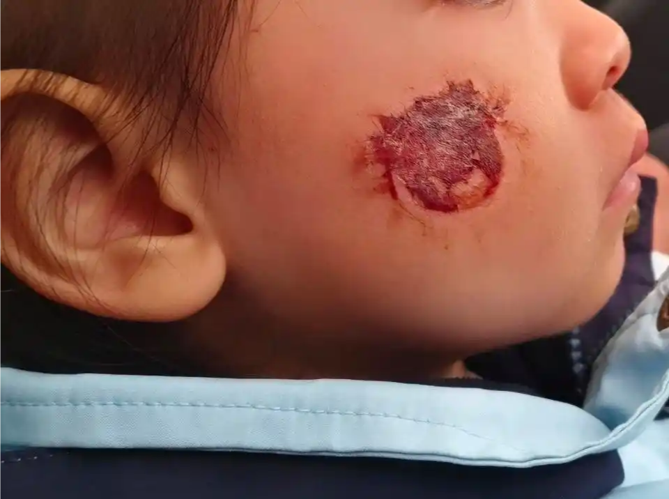 “毒贴纸”致3岁女童患急性接触性皮炎 这些儿童玩具也暗藏风险 