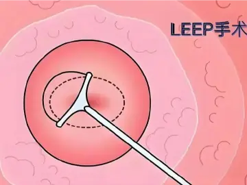 专家科普|给宫颈“纠错”的LEEP术,到底是啥操作?