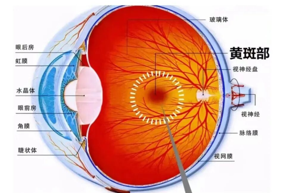 眼白长黄斑，是得了“黄斑病”？别搞错！医生：此斑非彼斑