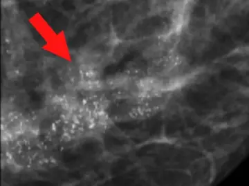 专家科普|乳腺报告有“钙化”,怎么办?