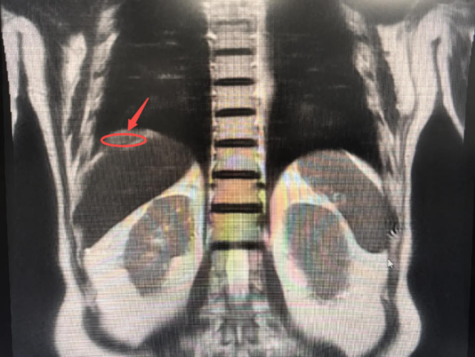 四大难题缠身，手术如何破局？肝胆外科为特殊老人完成高难度“拆弹”