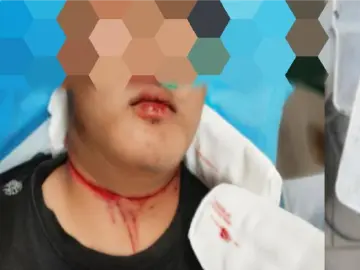 命悬一线!18岁男子气管完全断裂,深圳市南山区人民医院6小时多学科营救