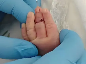 助产士剪断新生儿手指，反省几天即返岗 ？院方合规吗？律师解读 | 读特普法