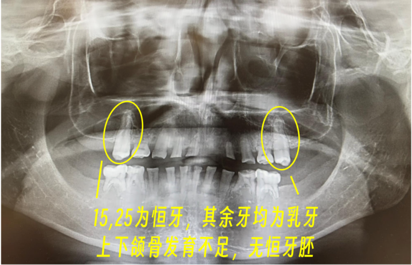 深圳15岁男孩还没换牙，求医10年，在深“重建”一口好牙