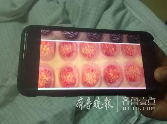女子9天拔罐27次致昏迷 起诉养生馆
