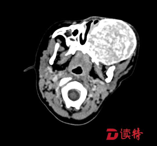 2岁宝宝被成功摘掉面部巨大肿物，手术难度之大难以想象
