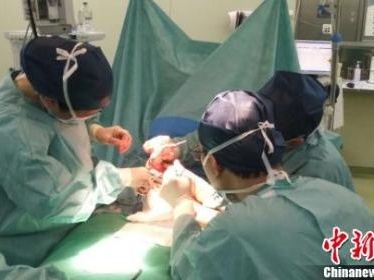 全球罕见的“三条腿”男婴在上海成功接受手术