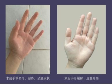 ​双手湿哒哒怎么办？做个微创手术就能解决