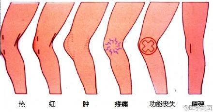 55岁以上人群八成患有骨关节炎