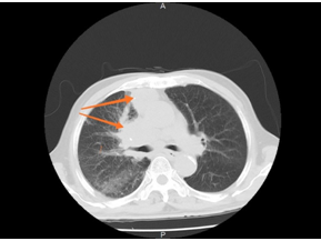 年年体检发现肺癌还是晚期？ 专家提醒：X光片做不了肺癌早筛！ 