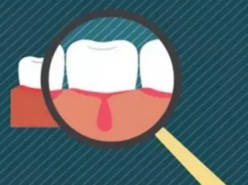 牙龈总出血究竟为哪般？