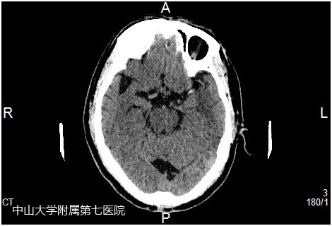 男子一觉醒来全身无力突然“中风” ！这种“烧脑”疾病要注意