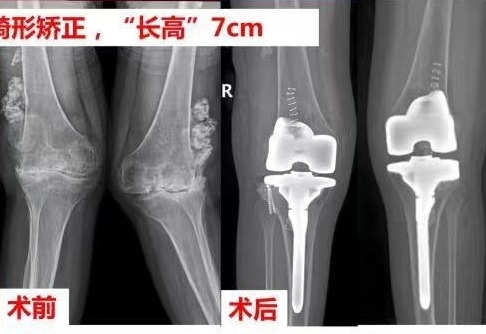 “X”型腿让她羞于穿裙子，换上金属膝盖后还长高7厘米