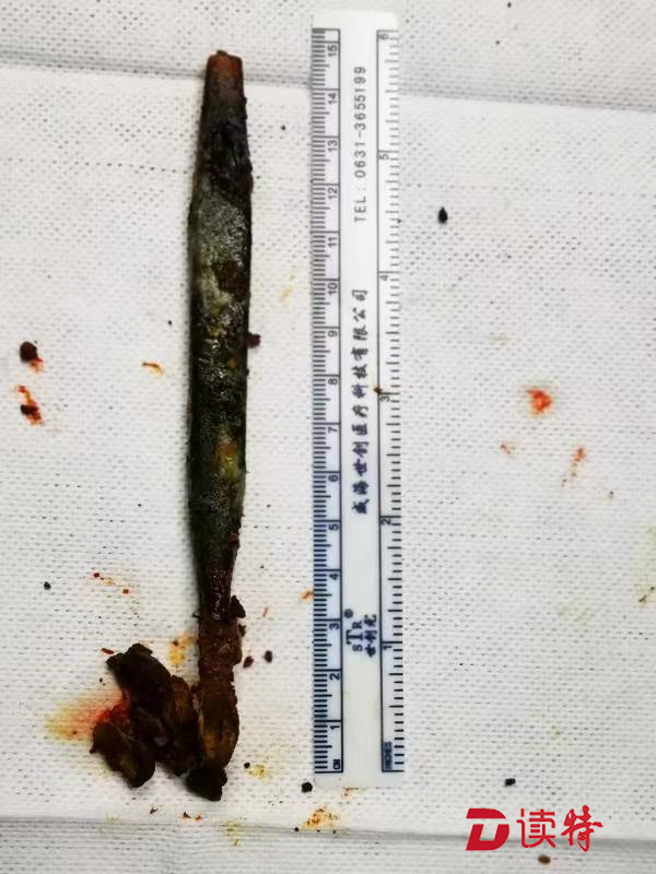 慎点！男子生吞牙刷，20年后将其拔出，没想到牙刷竟变成了这样！