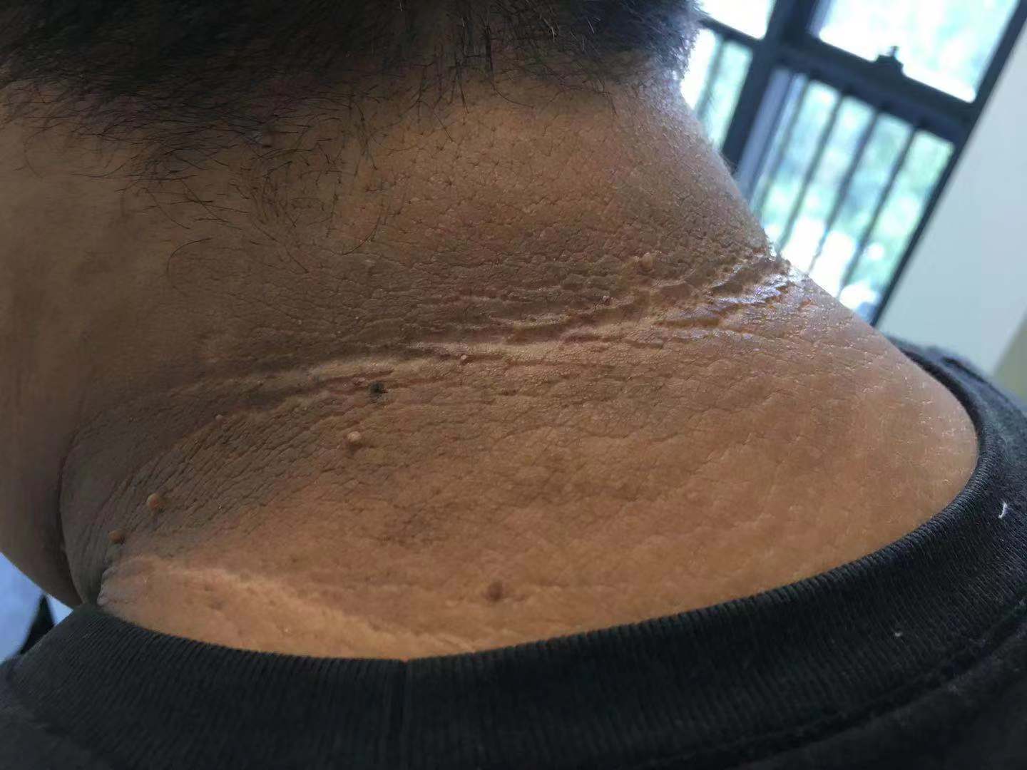 皮肤变黑还洗不干净？你有可能患上黑棘皮病
