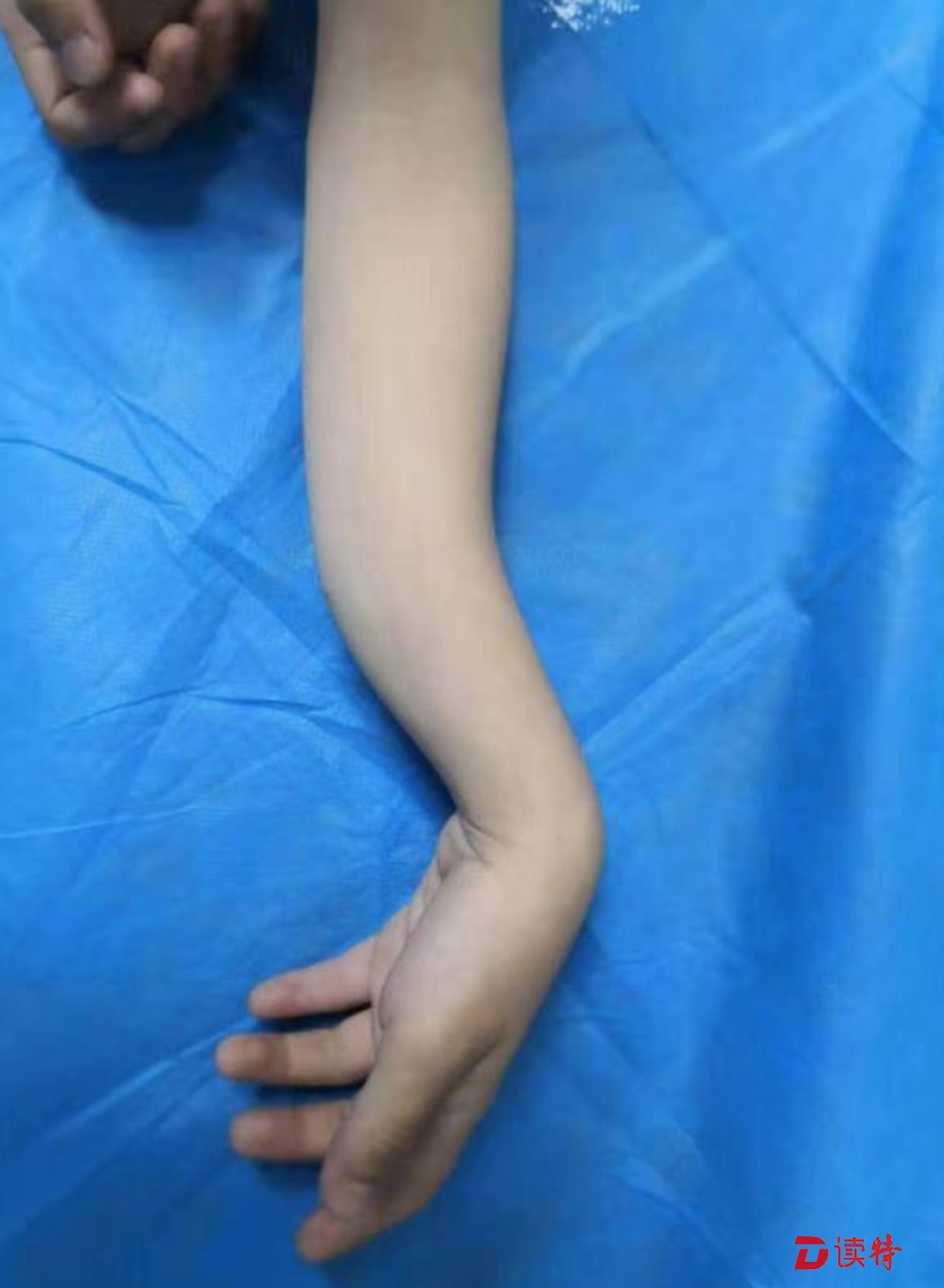 8岁男童蹦床蹦进手术室，儿童摔伤高发家当要“长点心”