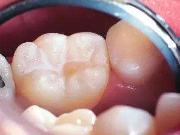 “窝沟封闭”牙齿烂得更快？医生：窝沟封闭能有效预防龋齿