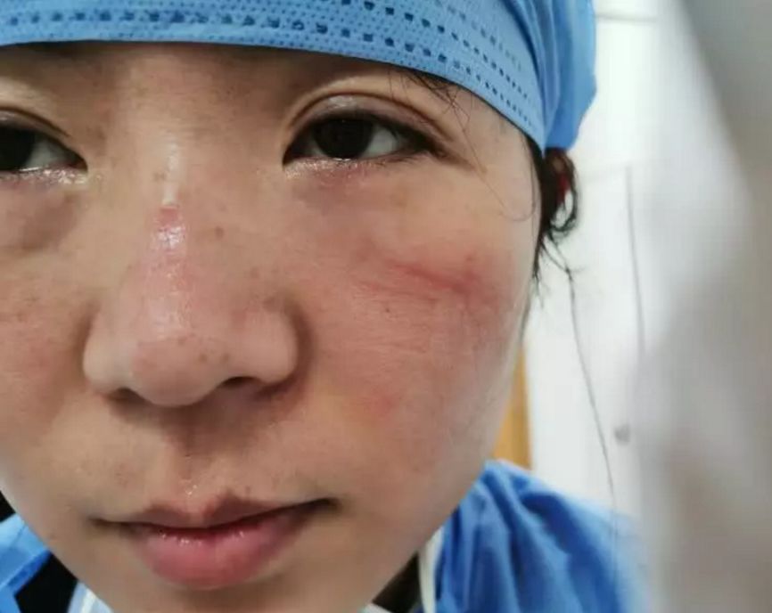 长时间戴口罩致皮肤不适？ 解决办法来了！
