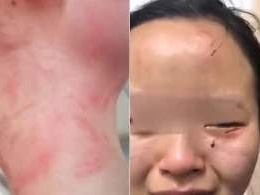 广州护士被外籍确诊男子咬伤最新进展，护士暂未发现异常