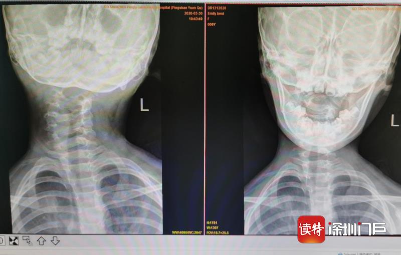 深圳6岁女孩“歪脖子”数月，罪魁祸首竟是它……