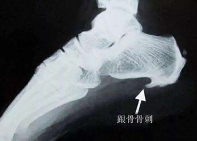 长了骨刺就必须要“除掉”？听听专家怎么说……