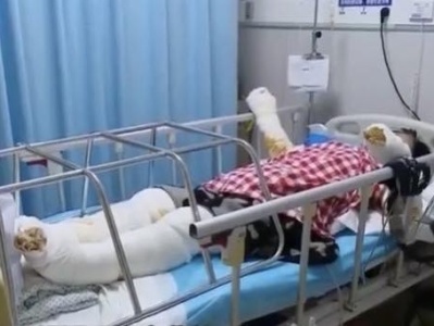 深圳一女子在家中疑被雷击，四肢烧伤严重