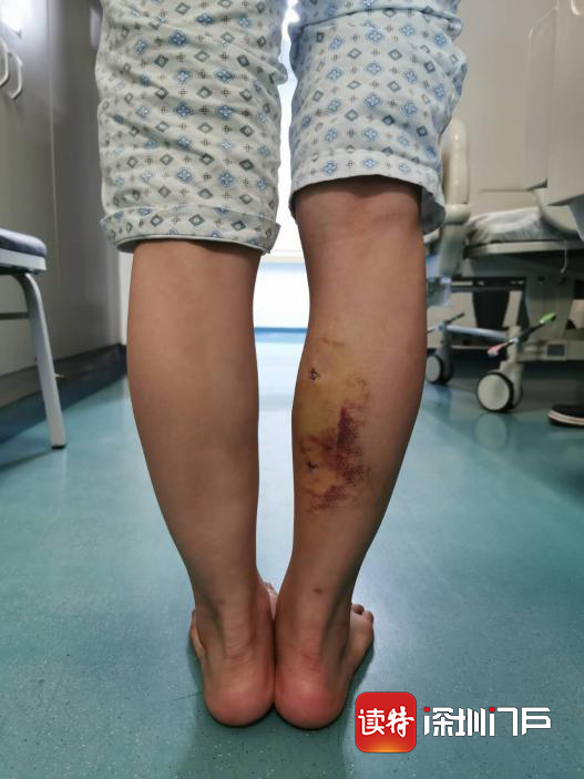 少女打瘦腿针求美  不料数月后双腿长短不一 多方求医后  微创手术2个小切口解决问题
