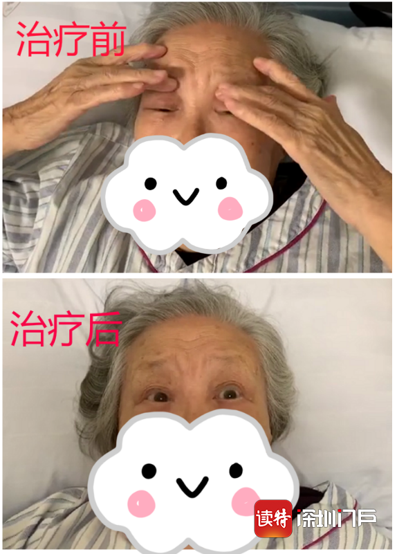八旬阿婆睁眼全靠手扒，原来是重症肌无力惹的祸
