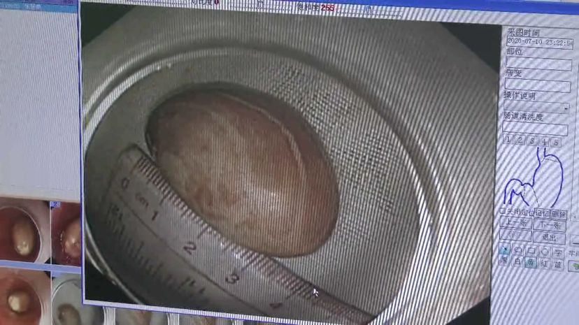 极速真探 | 当心！有人因一块菠萝蜜差点食管破裂 有这个习惯要注意了……